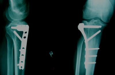 Synthes Buttress Plate (Implant 189)